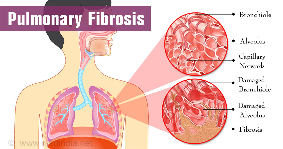 lung fibrosis causes