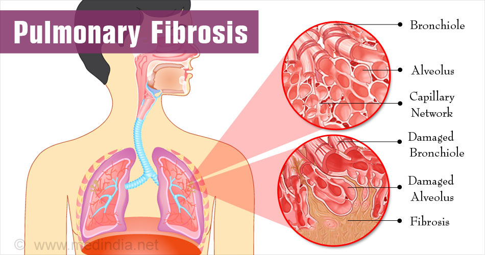 Interstitial Lung Disease Symptoms Causes Types KQTRUC
