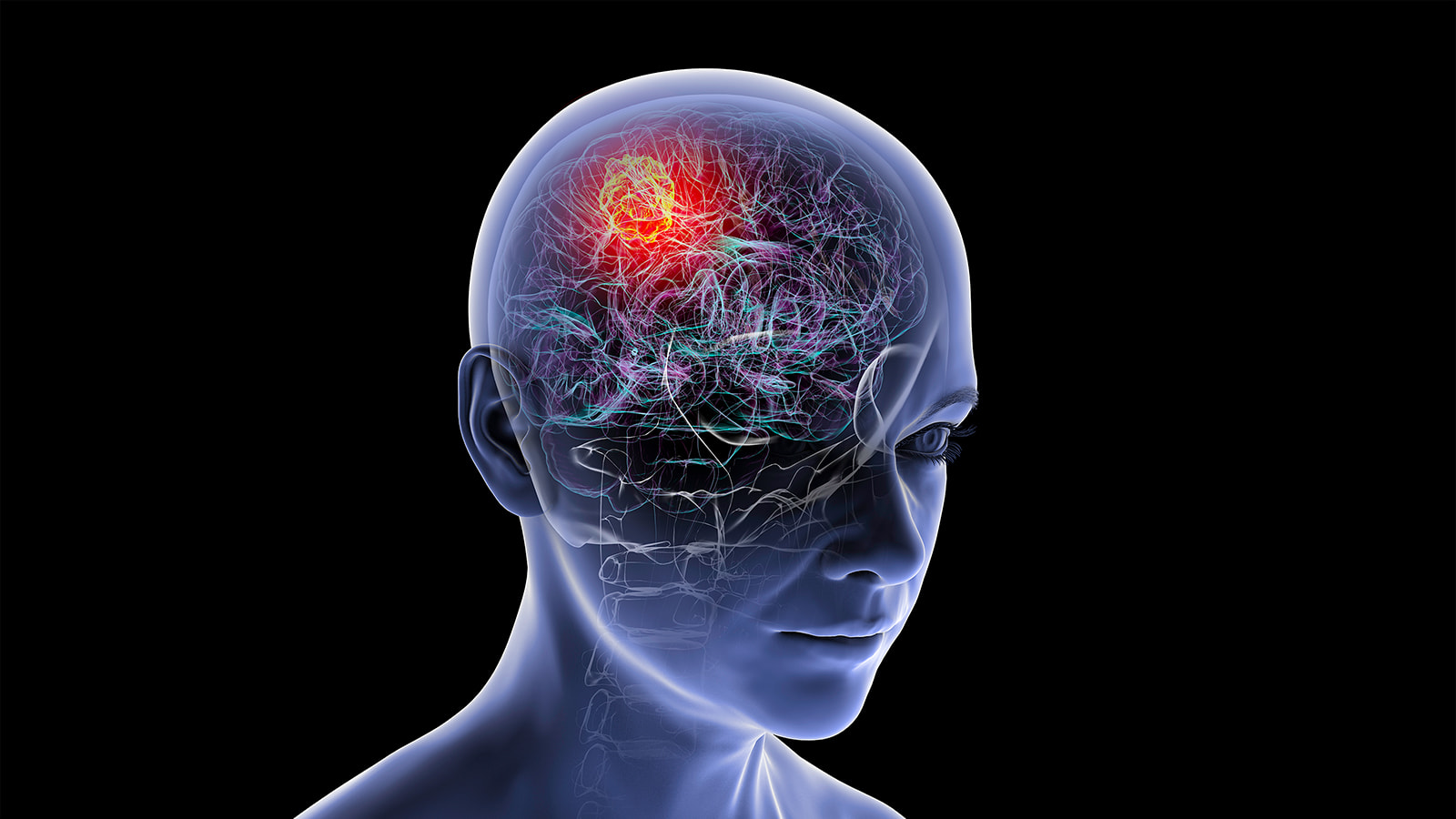 A translucent 3D medical illustration depicts a bright red and yellow glowing mass representing a glioblastoma brain tumor within an intricate neural network. (Photo: Getty Images)
