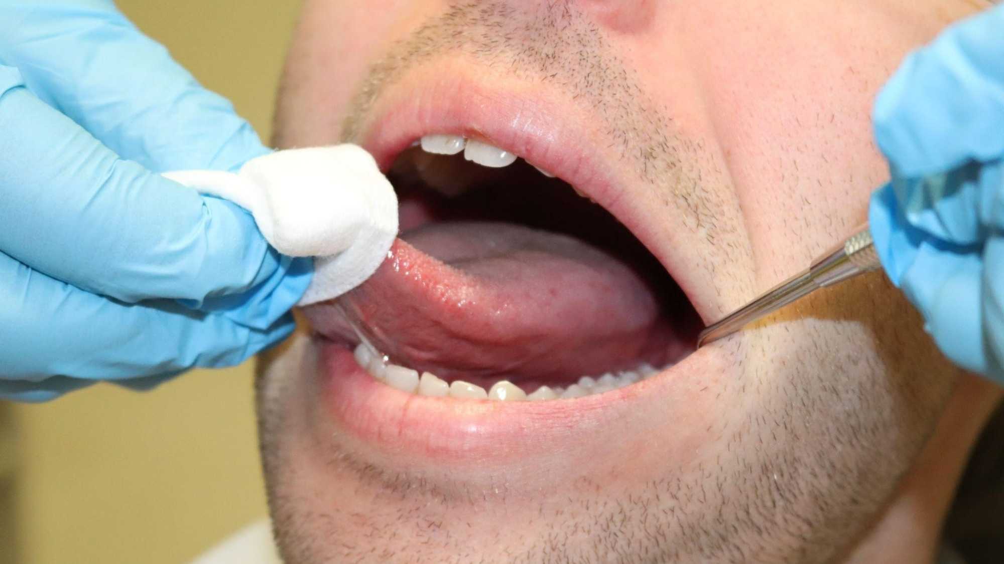 Intraoral examination of the lateral tongue using gauze retraction