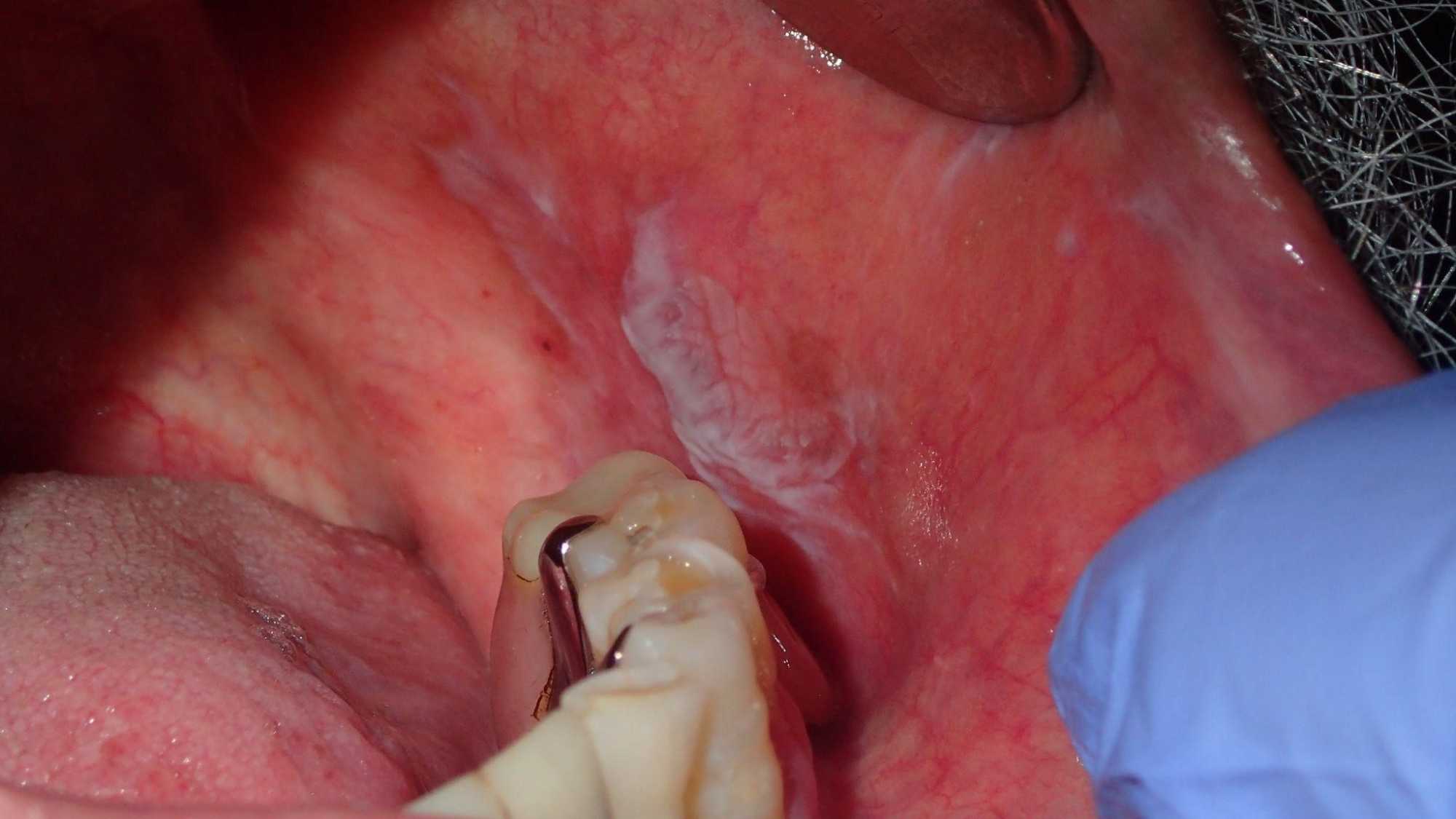 Mixed red and white lesion