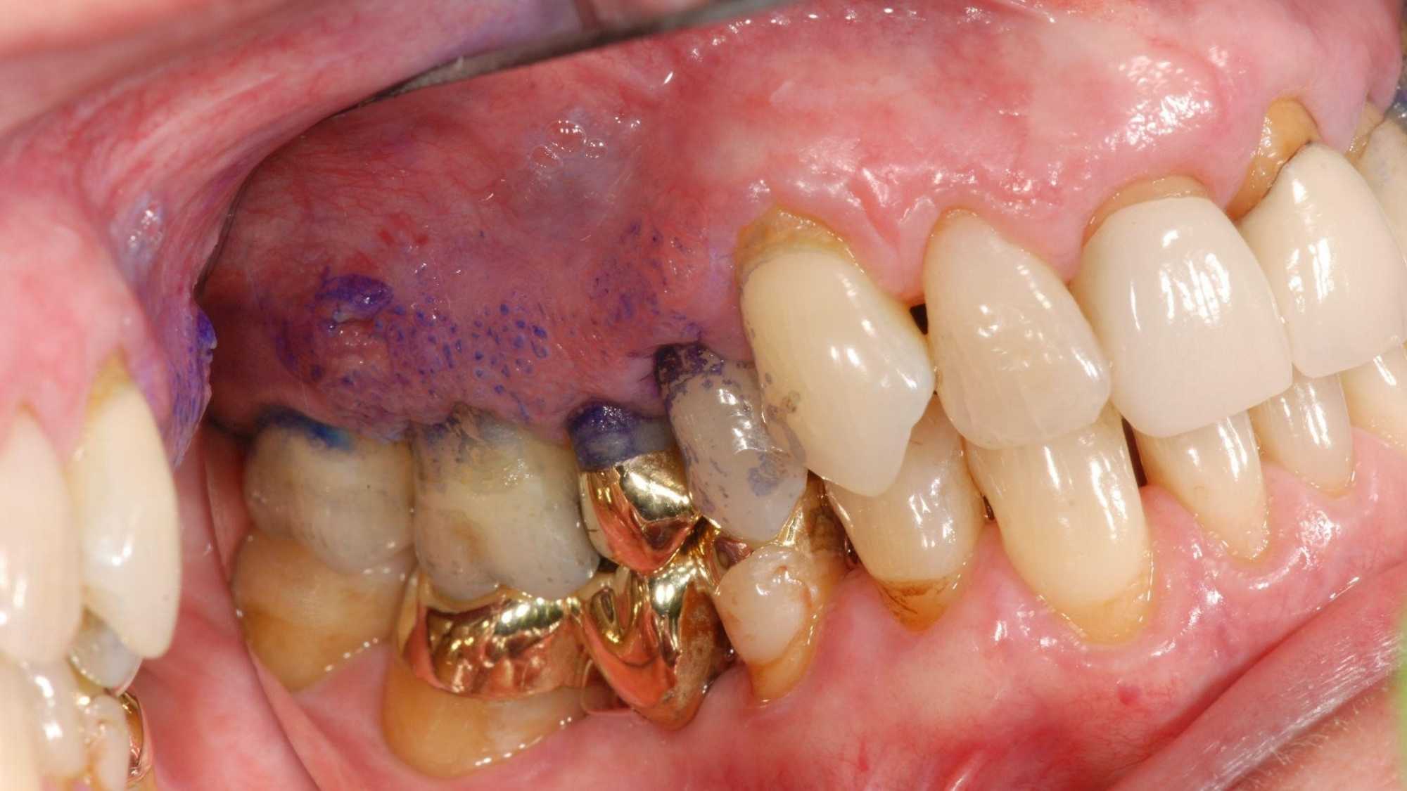 Irregular keratotic and erythematous lesion