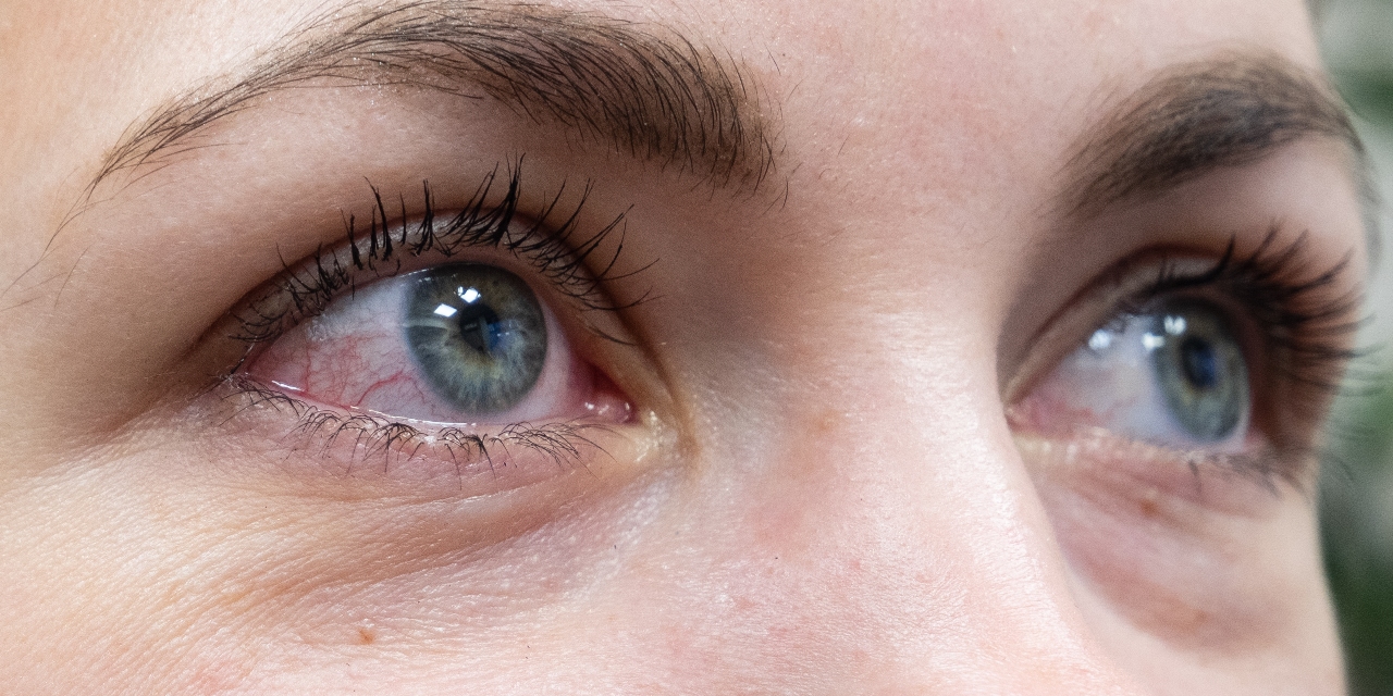 U of A clinician-scientists identify pink eye as possible primary symptom of COVID-19 | Folio