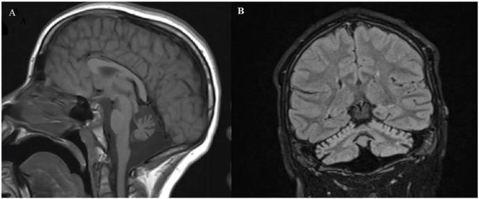 Cayman ataxia MRI