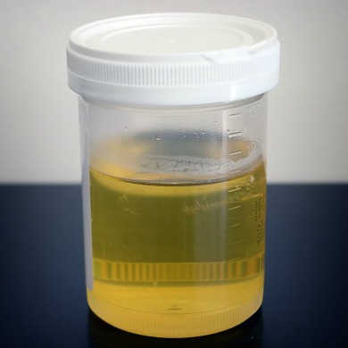 Human urine in a urinalysis tube