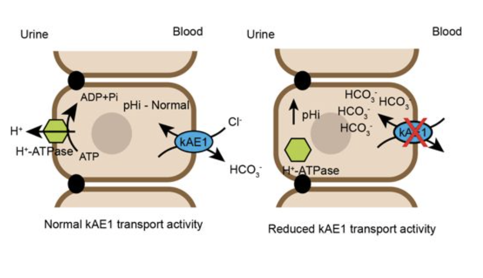 kAE1 dysfunction