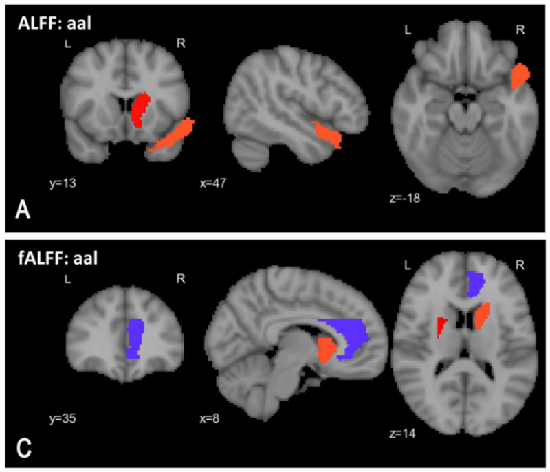 Study by UAlberta researchers uses machine learning to identify schizophrenia in brain scans.
